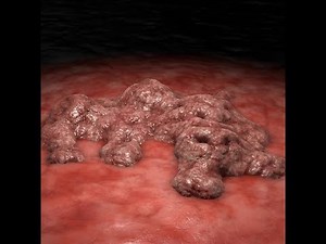 Stage 4 Cancer Here is How It Destroys The Body