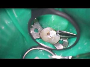 Management of root canal with open apex with calcium silicate based sealer.
