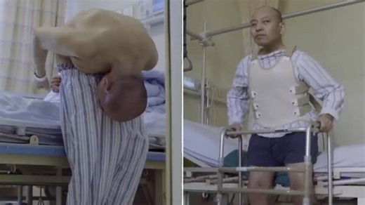 Man who spent 28 years folded over double finally stands up straight after op