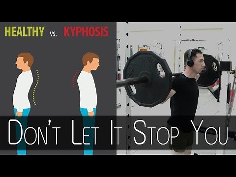 How I Squat with Kyphosis (Curved Spine)