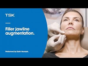 Filler jawline augmentation using cannula