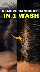 43K views · 3.3K reactions | Comment “hair “ for the link Winter = More Dandruff = More Hair Fall How to fix ? V No hot water V Use lukewarm water V Use shampoo with: * ��Salicylic Acid (kills dandruff) * ��Biotin (strong hair) * ��Pentavitin (smooth & silky) 3 washes = dandruff gone Comment “hair “ for the shampoo link. Anti dandruff shampoo, dandruff, hair care, dandruff solution , bare anatomt, bare anatomy anti dandruff shampoo, shampoo | Mr mann vaishnav | Facebook