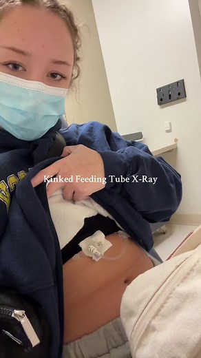 Understanding Gastroparesis and Tube Feeding Challenges