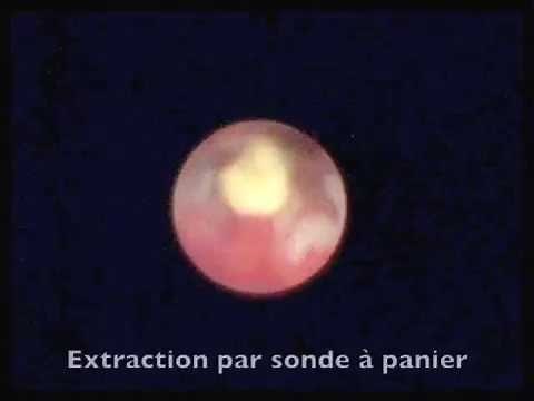 Sialendoscopy: extracting floatting salivary lithiasis by o probe basket