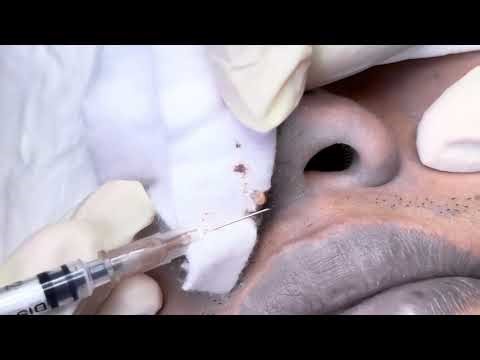 Extreme Acne & Scab Removal | Deep Pimple Popping for Severe Skin Recovery