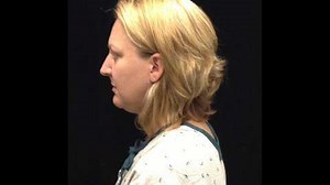 What is a Neck Lift?