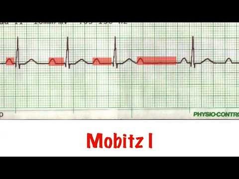 Read a rhythm strip in 5 min