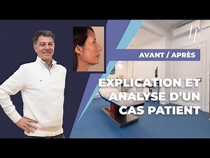 Cas Patient : rajeunissement global du visage et du cou avec les fils tenseurs permanents