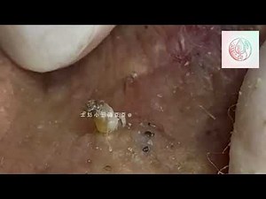 Deep Skin Recovery for Severe Acne