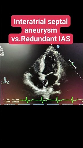 Interatrial septal aneurysm vs.Redundant interatrial septum