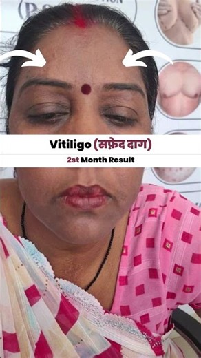Understanding Vitiligo & How to Manage It ✨