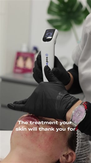 El tratamiento con Dermapen estimula la producción natural de colágeno y elastina mediante microperforaciones controladas, mejorando la textura de la piel, líneas finas, poros, manchas y cicatrices. Es un procedimiento mínimamente invasivo que ayuda a conseguir una piel más luminosa, uniforme y renovada. En Dermaclinic Spain personalizamos cada sesión según las necesidades de tu piel. 📍 Av. de l'Albir, 161, Local 1, 03581 – Alfaz del Pi 📞 34 674 25 55 79 - Dermapen is a microneedling treatment