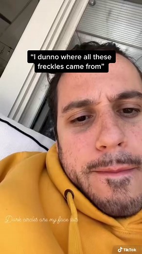 Sunscreen Skincare: How To Get Freckles Safely