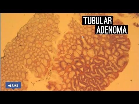 Tubular Adenoma