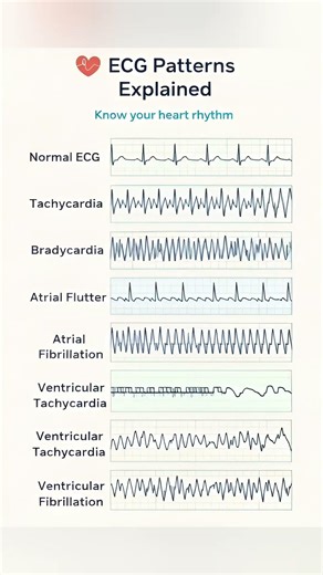 ECG Patterns You MUST Know 🫀 | Heart Rhythm Explained #shorts