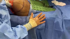 Removal of Illegal Silicone Injections from Buttocks, Hips, and Lymph with Open Incision Technique