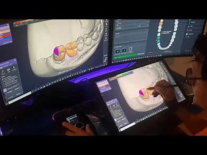 Exocad - Reduced Crown with Huion Kamvas 20