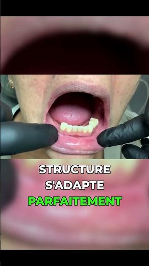 Fabrication et entretien des prothèses flexibles