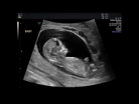 12 WEEK ULTRASOUND! MY BABY MOVING & HEARTBEAT!