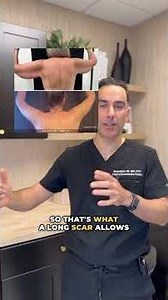 Arm Lift - aka Brachioplasty