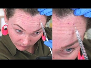 People Injecting Fillers into Their Own Faces?