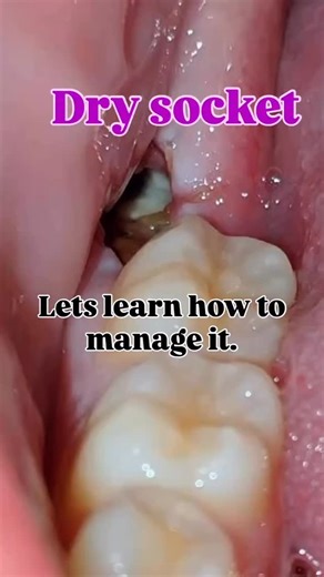 Dentistry My World 🌍 on Instagram: "❗ What is Dry Socket? @the_dental_fusion 👏 Dry socket occurs when the blood clot at a tooth extraction site dislodges or dissolves prematurely, leaving the bone exposed 🦴. This can cause severe pain 😖, delayed healing ⏳, and sometimes a foul taste 🤢. 🔥 Common Causes: • 🚬 Smoking or tobacco use • 🥤 Drinking through straws • 🦷 Poor oral hygiene • ⚡ Traumatic or difficult extraction • 🔁 History of dry socket 🔍 Signs & Symptoms: • 😫 Severe pain 2–4 day