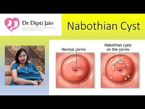 Nabothian cysts (HINDI)