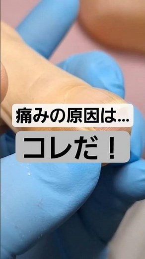 これが原因でずっと痛かった！皮膚に刺さる切り残しの巻き爪 【寒河江巻き爪フットケアセンター】