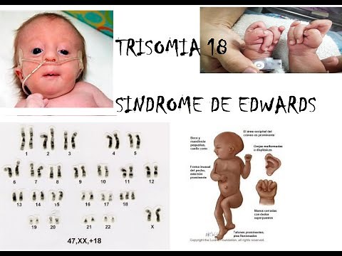 Síndrome de Edwards TRISOMIA 18
