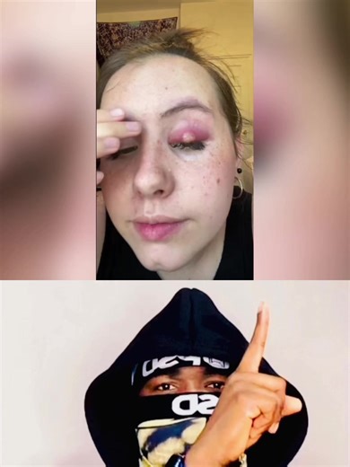 Common Causes and Remedies for Eye Styes