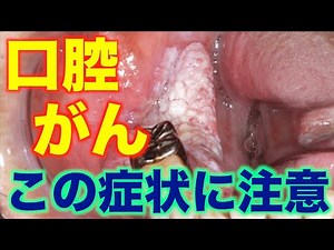 口腔がん（歯肉がん・舌がん）の症状｜原因と予防法を歯医者が徹底解説します！