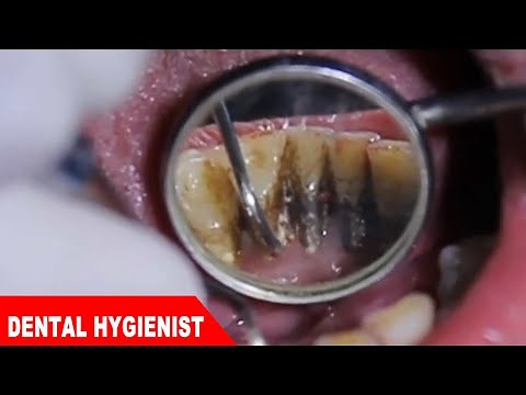 Extreme Dental Cleaning 2 - Black teeth turned white !!