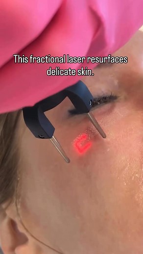🚨 DULUTH & SURROUNDING AREAS 🎉 Refresh and Rejuvenate Your Look with Our Exclusive Offer! ✨ 💖 "Bye Bye Baggy Eyes" is Here! 💖 Try our CO2 Laser Facial designed to support smoother, firmer skin around the eyes. PLUS, enjoy a Bonus red light therapy session and chlorophyll antioxidant serum for healing ✨ 💎 Just $347! (Reg. $599) 👇🔥 This offer may be ideal for those who: 🔥 Want to improve the appearance of loose or sagging skin under the eyes 🔥 Are seeking a non-surgical boost for a more r