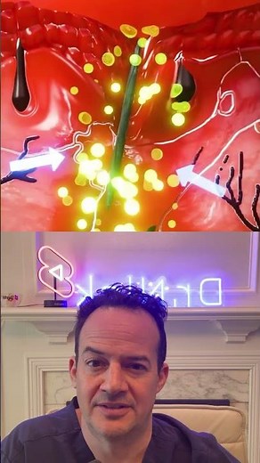 How to remove a splinter! 🤯