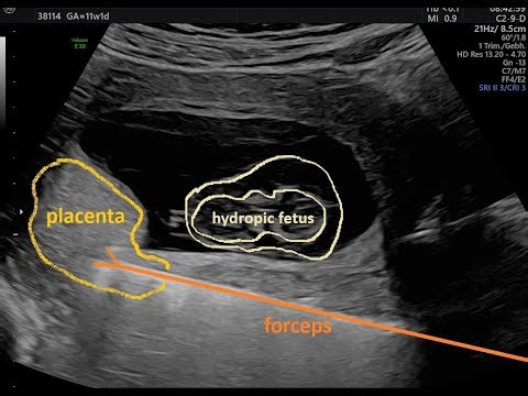 Chorionic Villus Sampling (transcervical) using the Rodeck Forceps