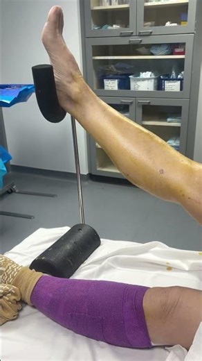 👀 Visual Evidence: Surgery vs No Surgery - RLS Treatment Actually Works!