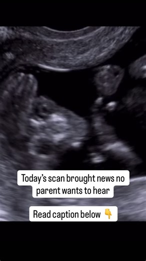 Dr Anu jain on Instagram: "What is anencephaly? Anencephaly is a serious birth defect in which a baby is born without a major part of the brain, skull, and scalp. It happens very early in pregnancy—often before a woman even knows she is pregnant. Why does it happen? During the first month of pregnancy, the baby’s brain and spinal cord start forming from a structure called the neural tube. In anencephaly, the upper part of this tube does not close properly, so the brain does not develop normally.