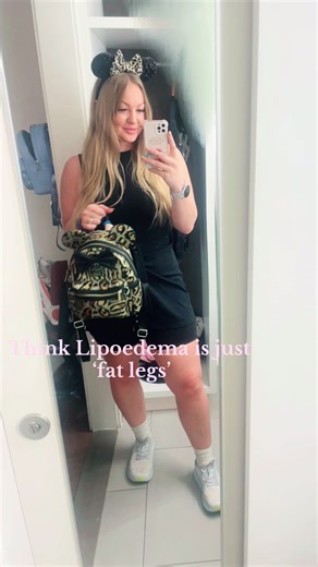 Understanding Lipoedema: Beyond Just Fat Legs