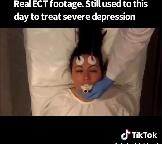 Understanding ECT: The Truth Behind Electroconvulsive Therapy