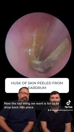 Eardrum Skin Peeling Procedure Explained