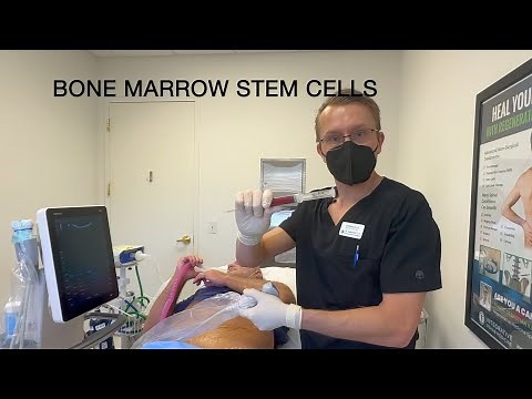 Hip Arthritis Treatment With Bone Marrow Stem Cells