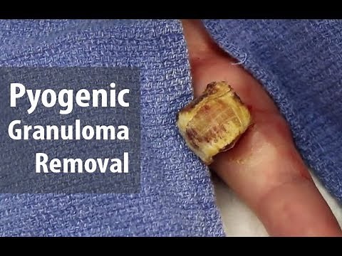 What are you holding? Let's cut it off! | Enormous Pyogenic Granuloma Removal | Dr. Derm