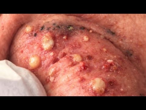 😨😱 ( Acne Treatment: How to Remove Pimples and Scars ) 