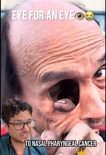 Nasopharyngeal cancer is a rare type of head and neck cancer that starts in the upper part of the throat—behind the nose. What makes it unique: • Often linked to the Epstein-Barr virus • More common in certain parts of Asia and North Africa • Can grow silently before symptoms appear Common symptoms: • Persistent nasal congestion or blockage • Nosebleeds • Hearing loss or a feeling of fullness in one ear • Neck mass from lymph node involvement Why it’s tricky: The location makes early detection d