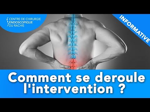 CHIRURGIE ENDOSCOPIQUE : Comment se déroule l'intervention ?