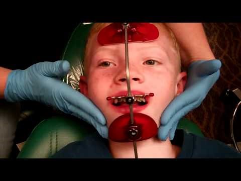 How to Wear and Remove Reverse Pull Headgear