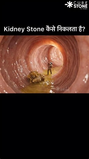 Cure Stone on Instagram: "Imagine shrinking down 100x and standing inside your own kidney! 🤯 Check out this animation that shows exactly how kidney stones move through your body. Here is the rule of thumb: ✅ 5mm: The stone is often too big to pass and might need medical intervention. Struggling with kidney pain? Don’t guess your treatment. 👉 Add WhatsApp your reports on +918800263884 for free consultation for kidney stones We provide expert analysis of your ultrasound or CT scan to tell you th