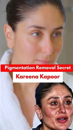 face pigmentation treatment at home | Remove pigmentation at home | #pigmentation problem