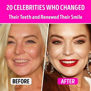 20 Celebrities Who Changed Their Teeth and Renewed Their Smile | CelebRatings