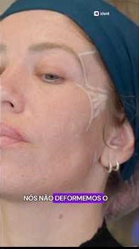 Do you know how to perform full face fillers in practice?